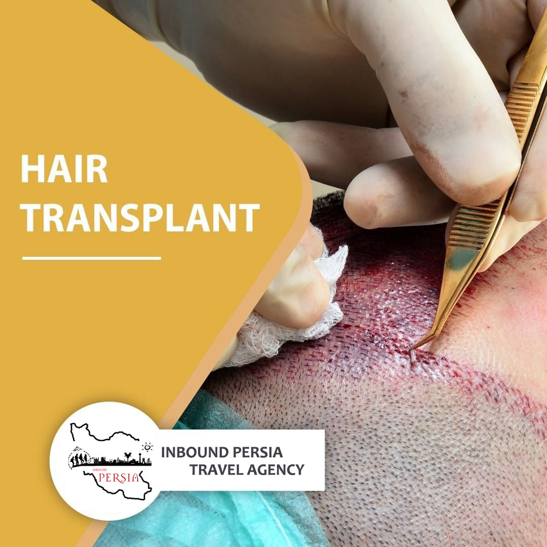 Hair Transplant in Iran