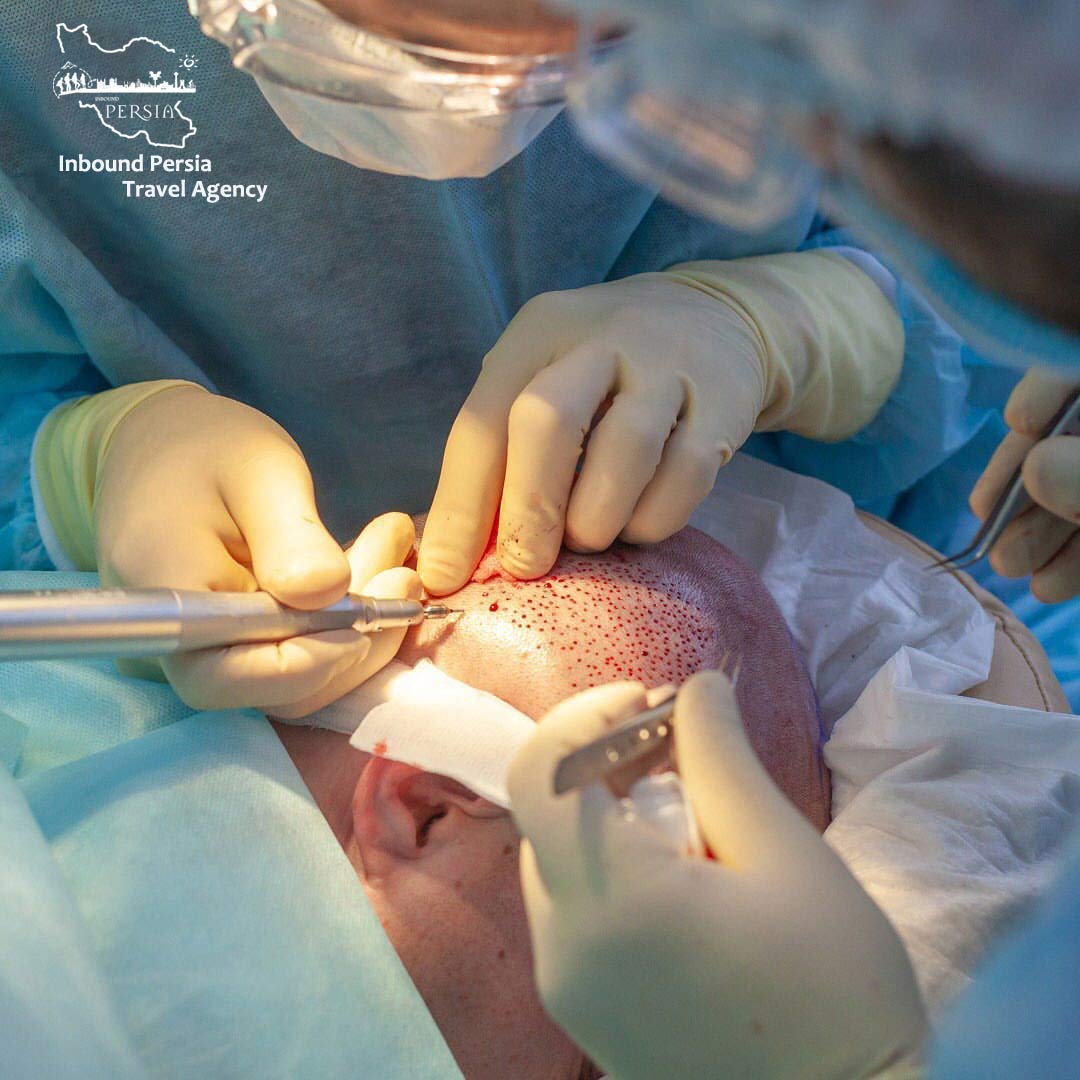 Hair Transplant in Iran